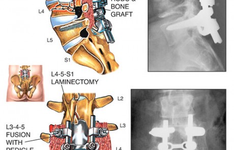 19.580 Million Settlement 2, 800V9-2, lumbar, spine, spinal fluid, vertebrae, pedicle, screws, rods, bone graft, x-ray, laminectomy, compression, fracture, thecal, nerve roots
