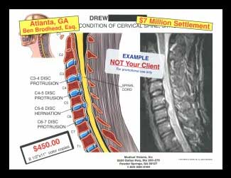 spine, cervical, disc protrusion, bulge, herniation, nucleus, annulus, annular tear, spinal cord c3-4, c4-5, c5-6, c6-7, MRI