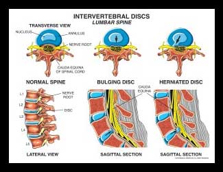 lumbar, spine, vertebrae, disc, bulge, herniation, protrusion, nerve root normal, nucleus, annulus, annular tear