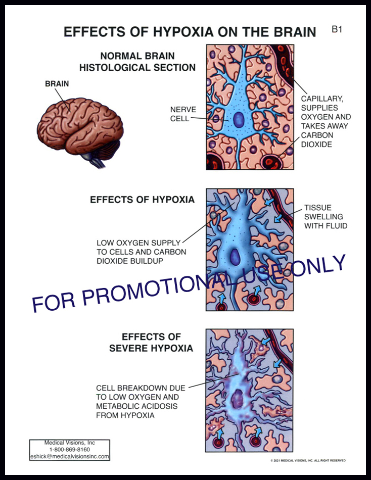B1 Effects of Hypoxia on the Brain