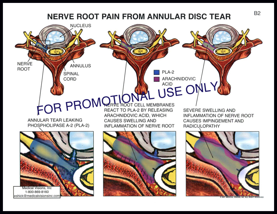 B2 Nerve Root Pain from Annular Disc Tear