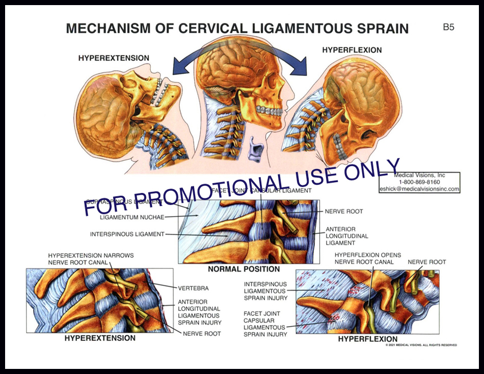 B5 Mech of Cervical Ligament Sprain