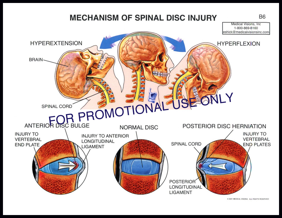B6 Mech of Spinal Disc Injury
