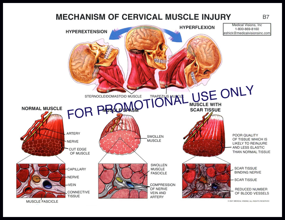 B7 Mech of Cervical Muscle Injury