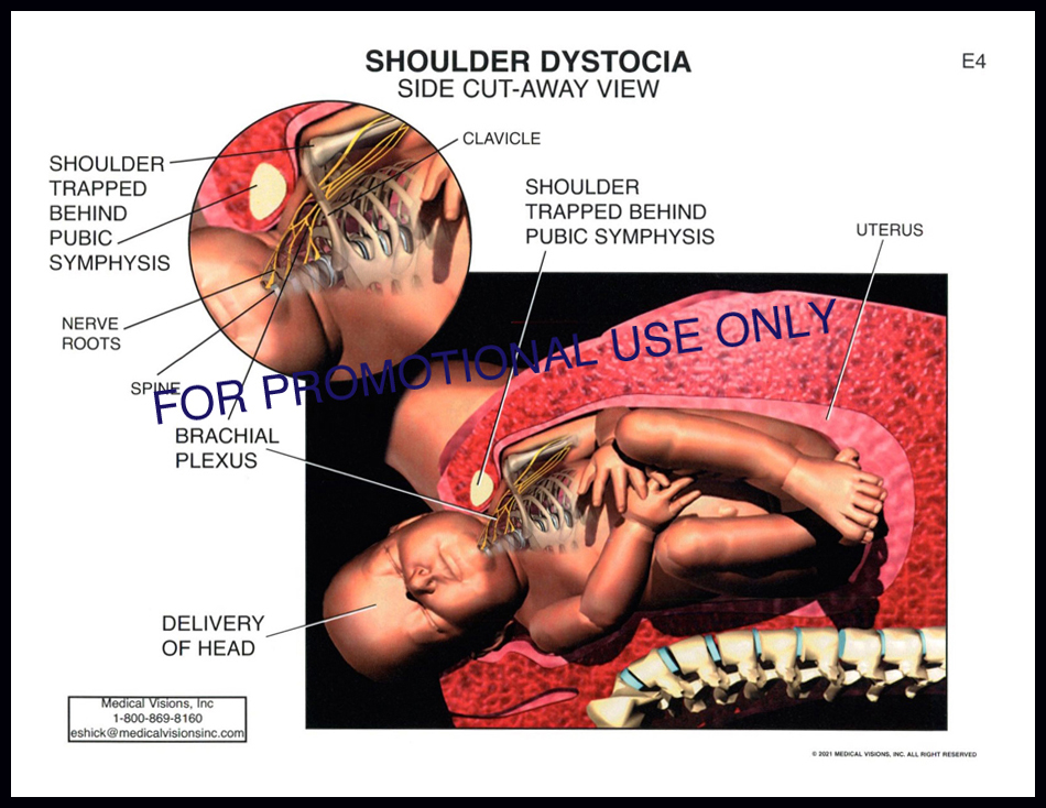E4 Shoulder Dystocia