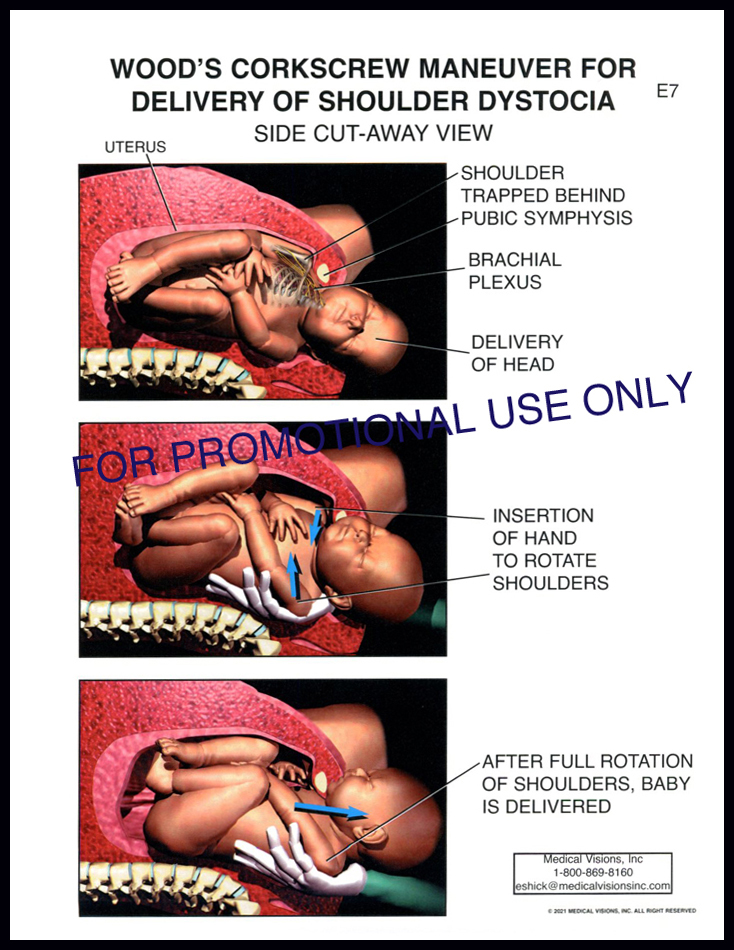 E7 Wood Corkscrew Maneuver