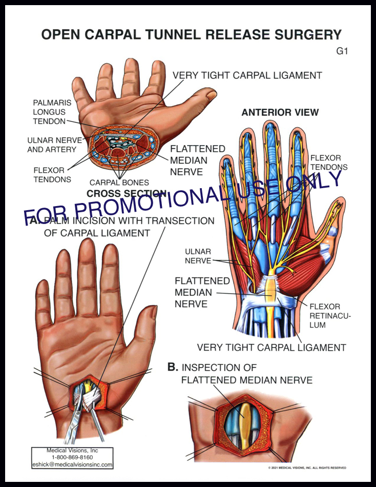G1 Open Carpal Tunnel Release Surgery
