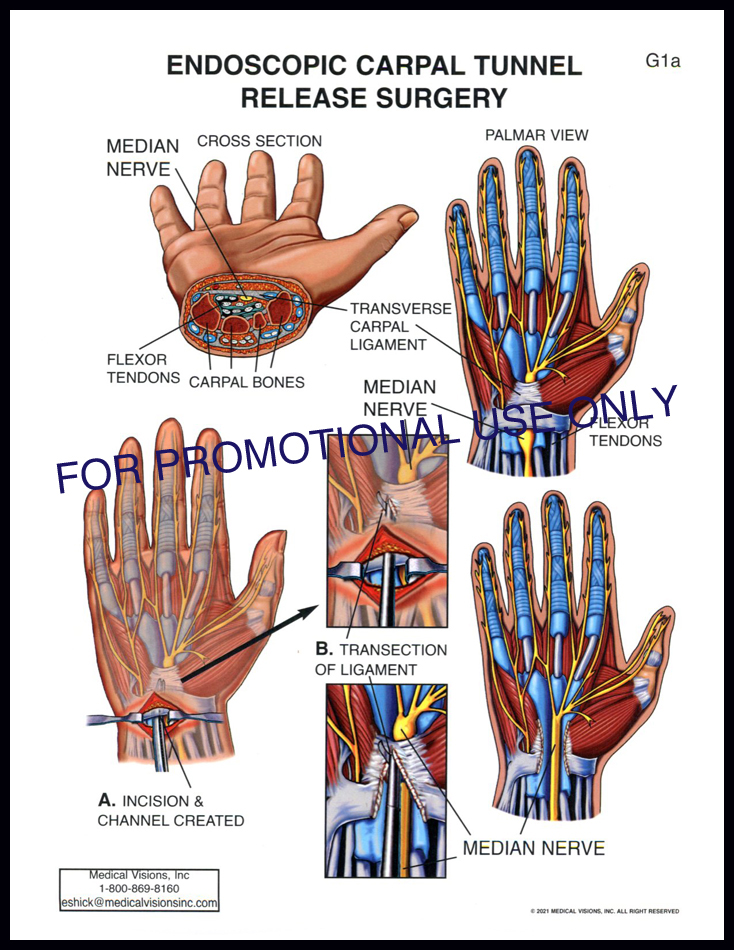 G1a Endoscopic Carpal Tunnel Release Surgery