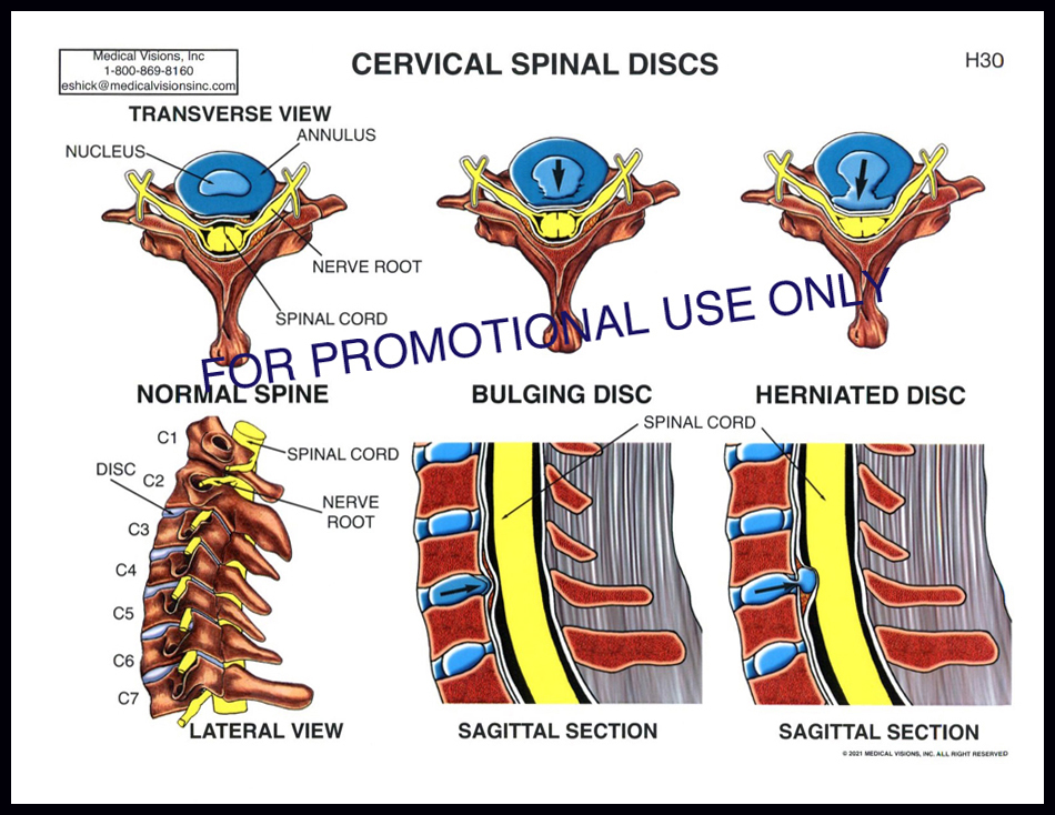 H30 Cervical Spinal Discs
