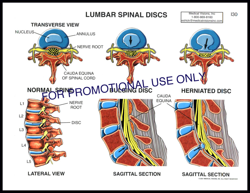 I30 Lumbar Spinal Discs