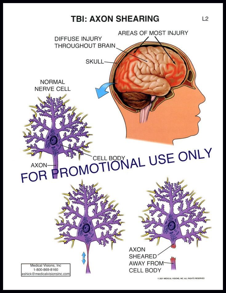 L2 TBI Axon Shearing