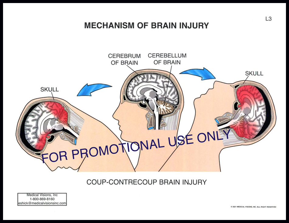 L3 Mech of Brain Injury