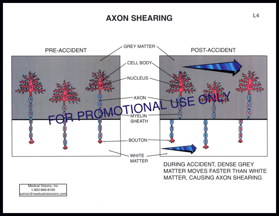 L4 Axon Shearing