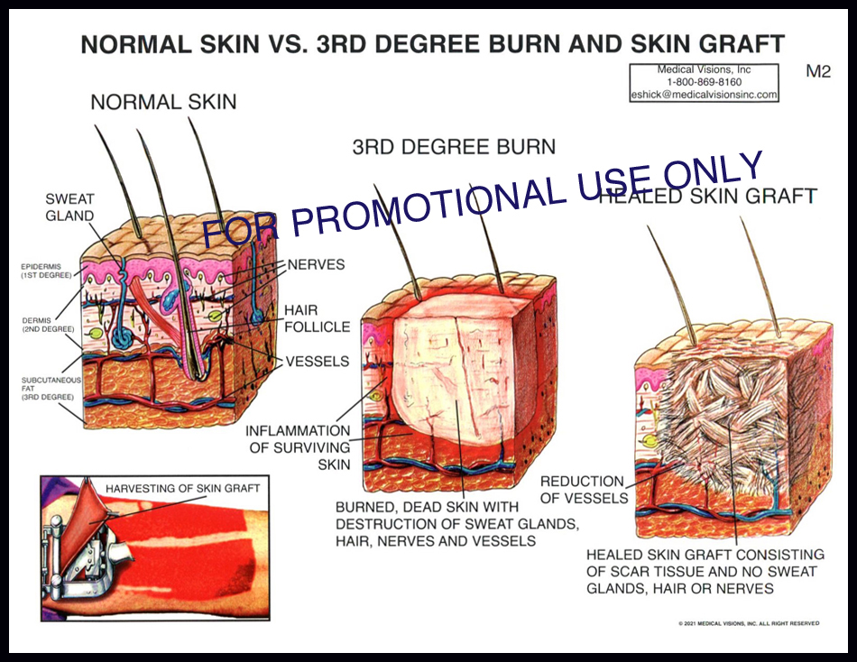 M2 Normal Skin vs 3rd Degree Burn