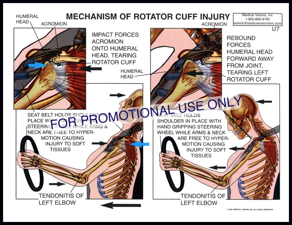 U7 Mech of Rotator Cuff Injury
