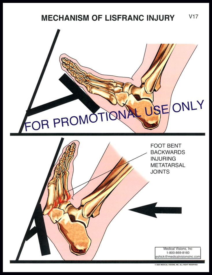 V17 Mech of Lisfranc Injury