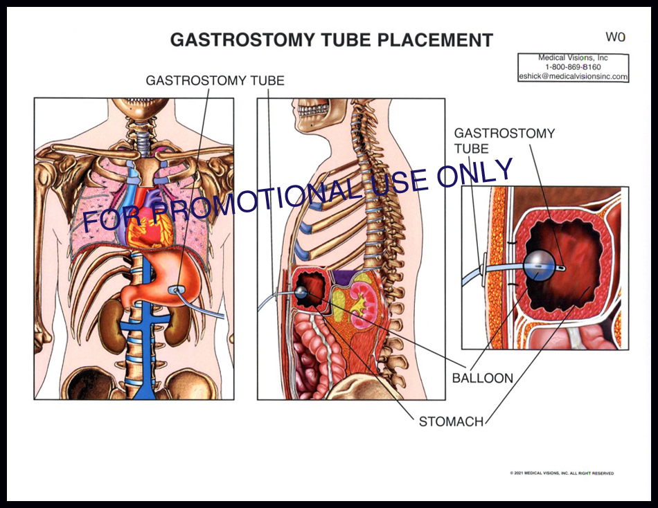 W0 Gastrostomy Tube Placement