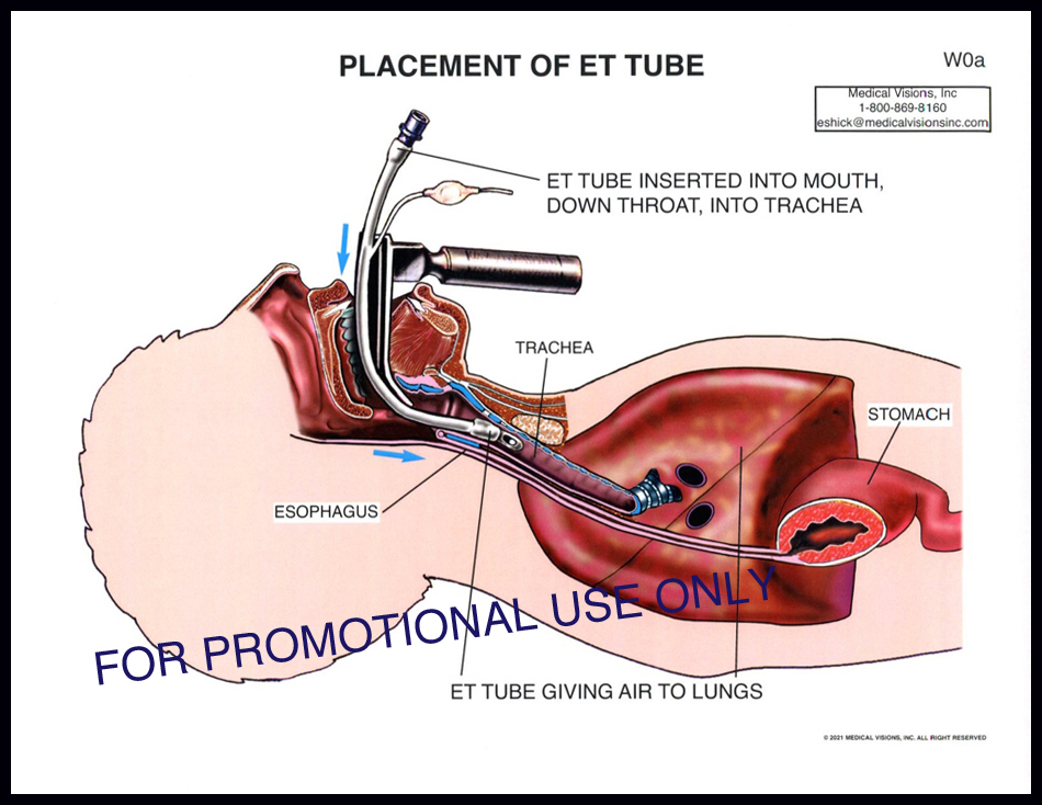 W0a Placement of ET Tube