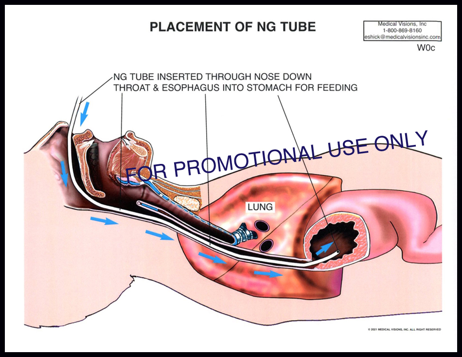 W0C Placement of NG Tube
