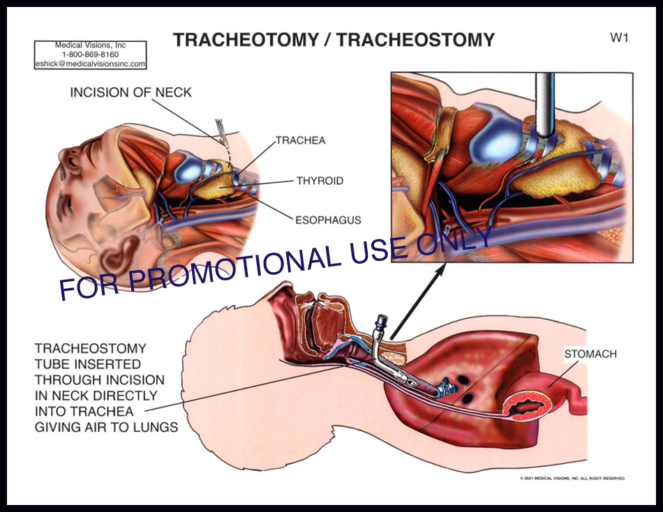 W1 Tracheotomy