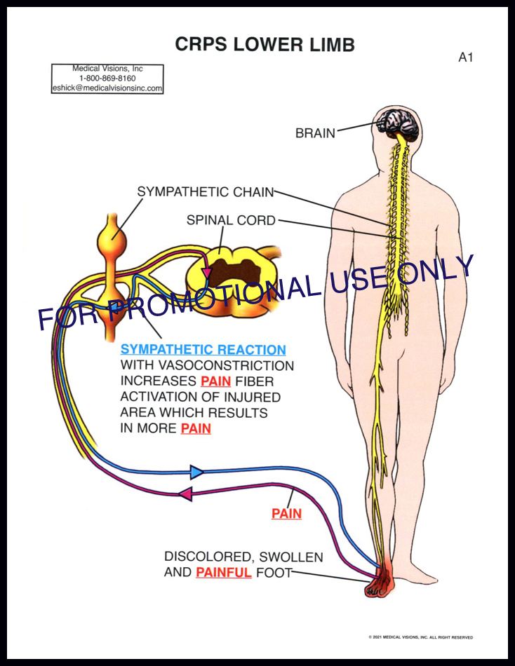 A1 CRPS Lower/Upper Limb