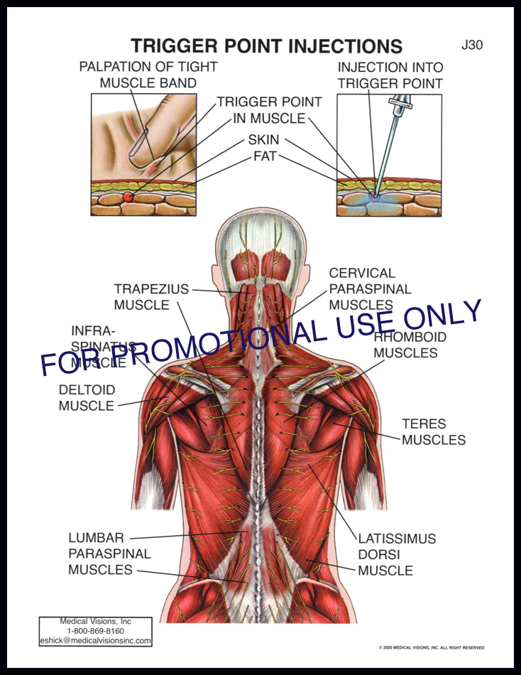 J30 Trigger Point Injections